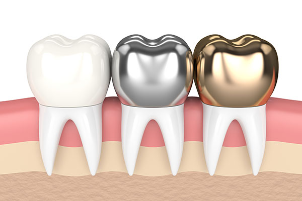 CEREC Crowns vs Traditional - Which Is Better, Bonded or Cemented in Place?