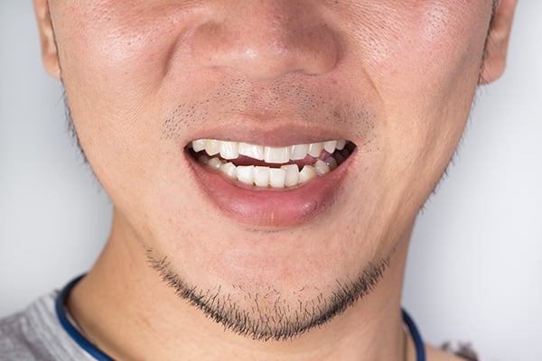 Can General Dentistry Repair a Knocked Out Tooth?