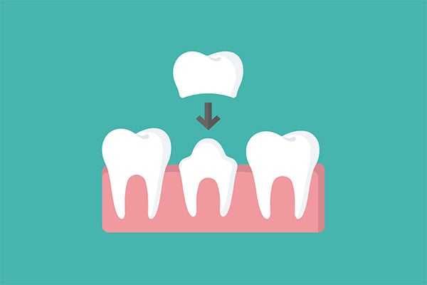 How a CEREC Crown Can Restore a Broken Tooth