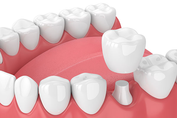 How a CEREC Restoration Can Help a Damaged Tooth